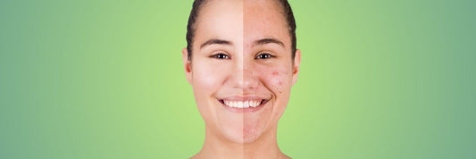 Decoding Period Acne: Expert Tips for Clearer Skin Before and During Your Cycle