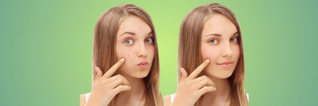 Your Guide to Spot Treating Period Acne